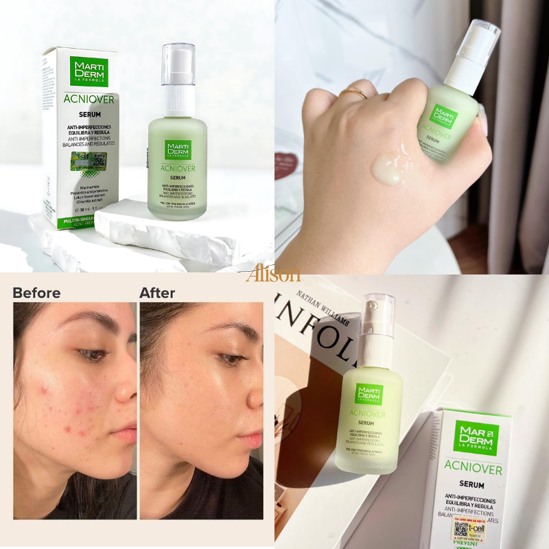 Serum Trị Mụn